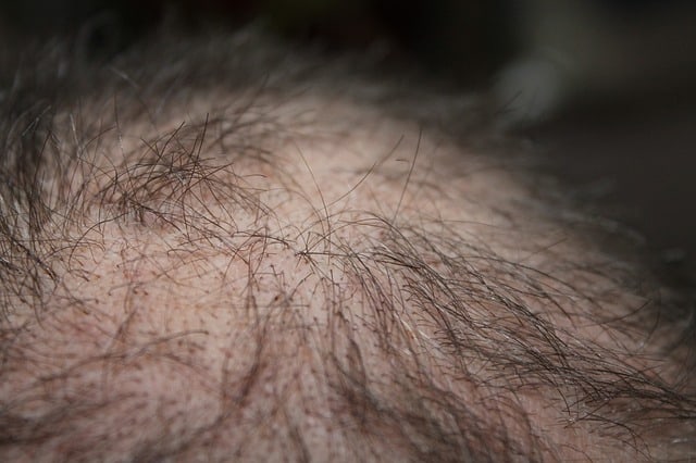 balding scalp